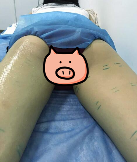 青島大學醫學院附屬醫院整形美容燒傷科陳振宇雙腿吸脂案例分享