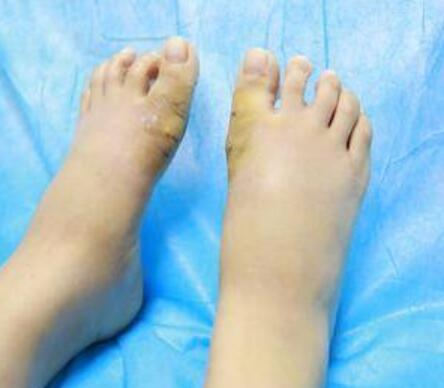 大同和平燒傷骨科醫院整形美容科大腳骨矯正案例分享