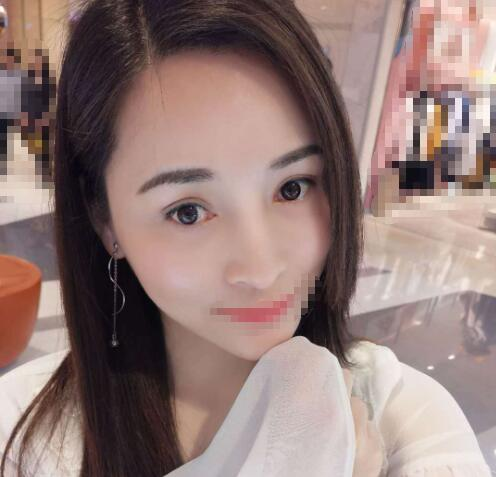 赤峰現代婦產醫院醫療美容科袁俊龍雙眼皮修復案例分享