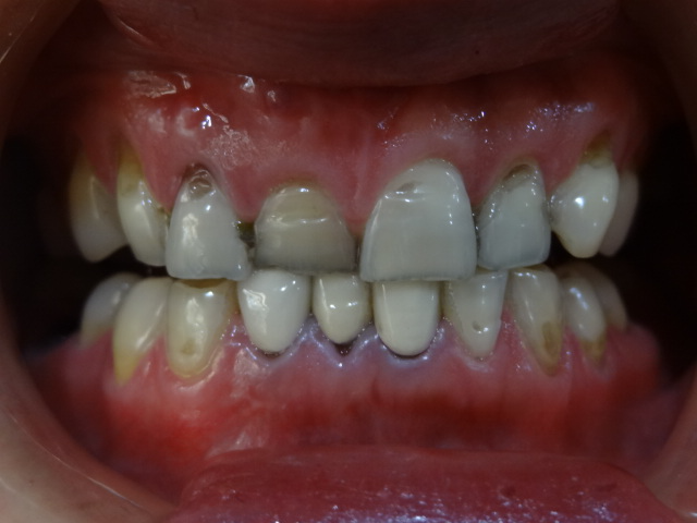 安徽天鵝湖口腔醫院周健醫生做超聲波洗牙效果怎么樣？附超聲波洗牙效果案例