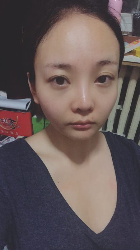 北京可思美醫療整形醫生蘇靜做臉部自體脂肪填充效果怎么樣？