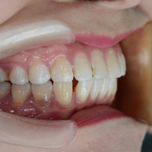 廈門拜博口腔醫院醫生張忠做牙齒隱形矯正怎么樣？附案例效果對比圖