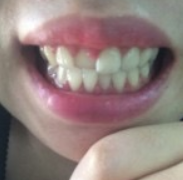 安徽天鵝湖口腔醫院張永莉醫生做牙齒矯正怎么樣？附牙齒矯正案例效果對比圖