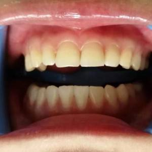 肇慶中大口腔醫院醫生伍雪紅做牙齒冷光美白怎么樣？附案例效果對比圖