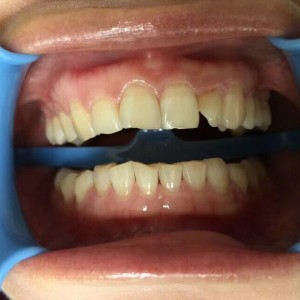 保定東陽口腔醫院王增光醫生做牙齒美白怎么樣？附牙齒美白案例效果對比圖