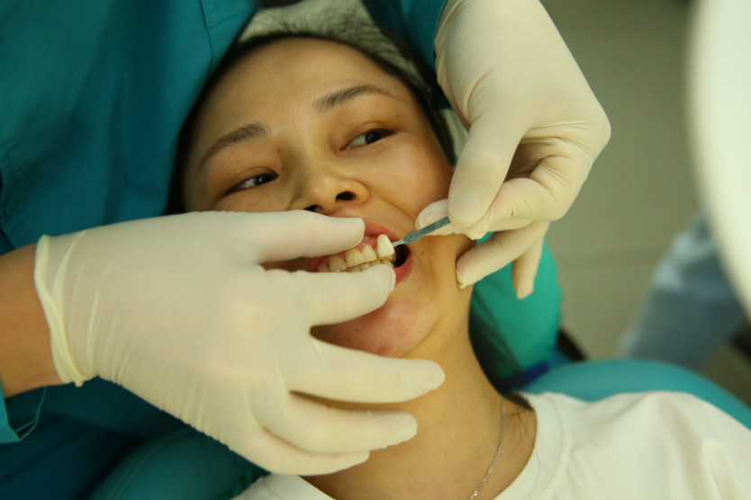 保定東陽口腔醫院趙星醫生做牙齒瓷貼面怎么樣?附牙齒瓷貼面案例效果對比圖