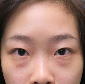 保定安卓貝拉醫療美容門診部孫大山醫生做雙眼皮+去眼袋怎么樣？附案例效果對比圖