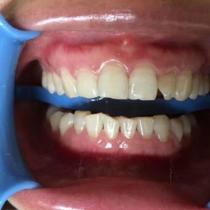 保定東陽口腔醫院王增光醫生做牙齒美白怎么樣？附牙齒美白案例效果對比圖