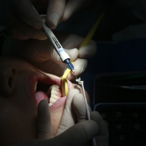 保定東陽口腔醫院興磊醫生做牙齒貼面怎么樣？附牙齒貼面案例效果對比圖