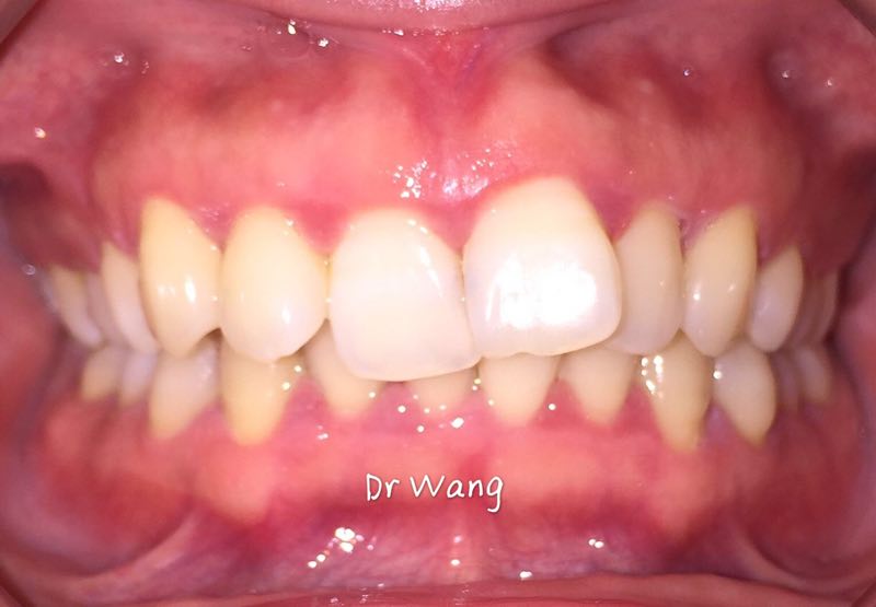 保定東陽口腔醫院白小青醫生做牙齒矯正怎么樣?附牙齒矯正案例效果對比圖
