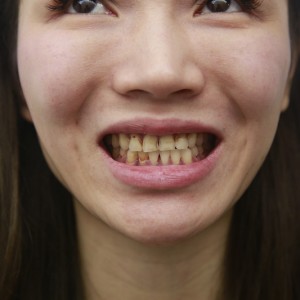 保定東陽口腔醫院興磊醫生做牙齒貼面怎么樣？附牙齒貼面案例效果對比圖