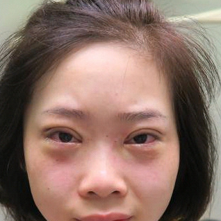 保定安卓貝拉醫療美容門診部孫大山醫生做雙眼皮+去眼袋怎么樣？附案例效果對比圖