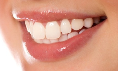 冷光美白牙齒需要多少錢？價錢貴嗎？