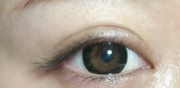 什么是雙眼皮定點？定點雙眼皮多久恢復？