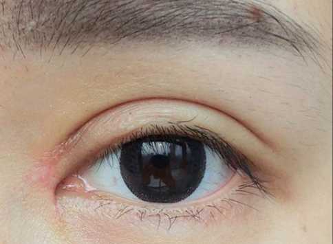 單眼皮做雙眼皮效果好嗎？手術費用大概是多少？