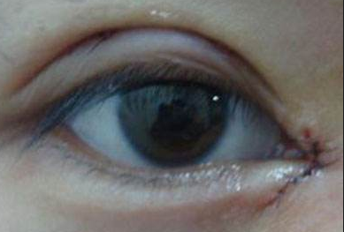 開眼角術后如何快速消腫？做完開眼角手術后還會反彈嗎？